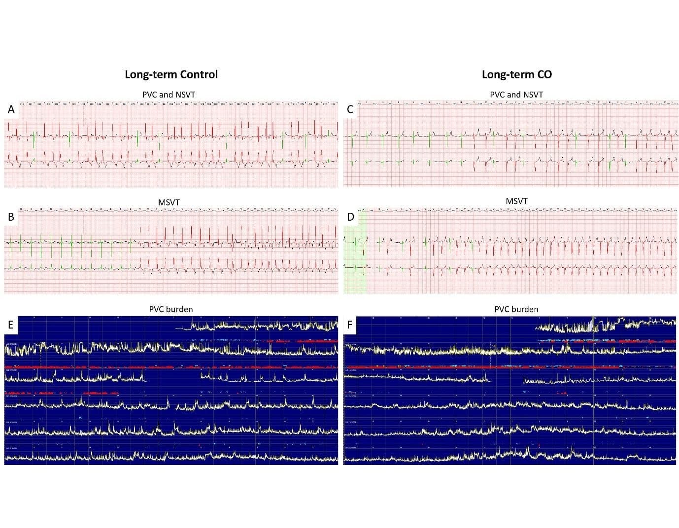 ECG readout at 30 days post-transplantation — no arrhythmogenic effects